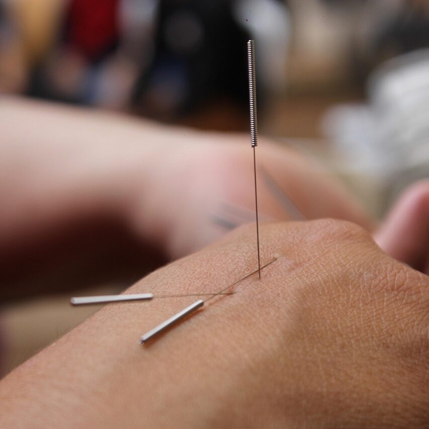 acupuncture, needles, hand, medicine, physiotherapy, therapy, traditional, wellness, skin, spa, closeup, acupuncture, acupuncture, acupuncture, acupuncture, acupuncture